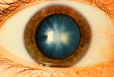 Irene McClain About Diabetes